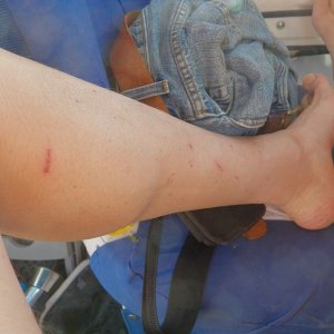 I carry Bactine with me and apply it like sunscreen (also required).  This is before I really got scratched up.