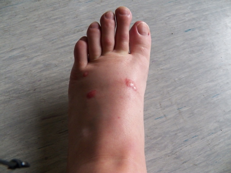 With sand flies, it took three days for the bites to develop.  This is after taking an antihistamine.
